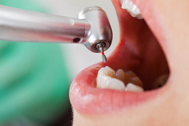 Best Dental Abscess Treatment in Lincoln Village, OH